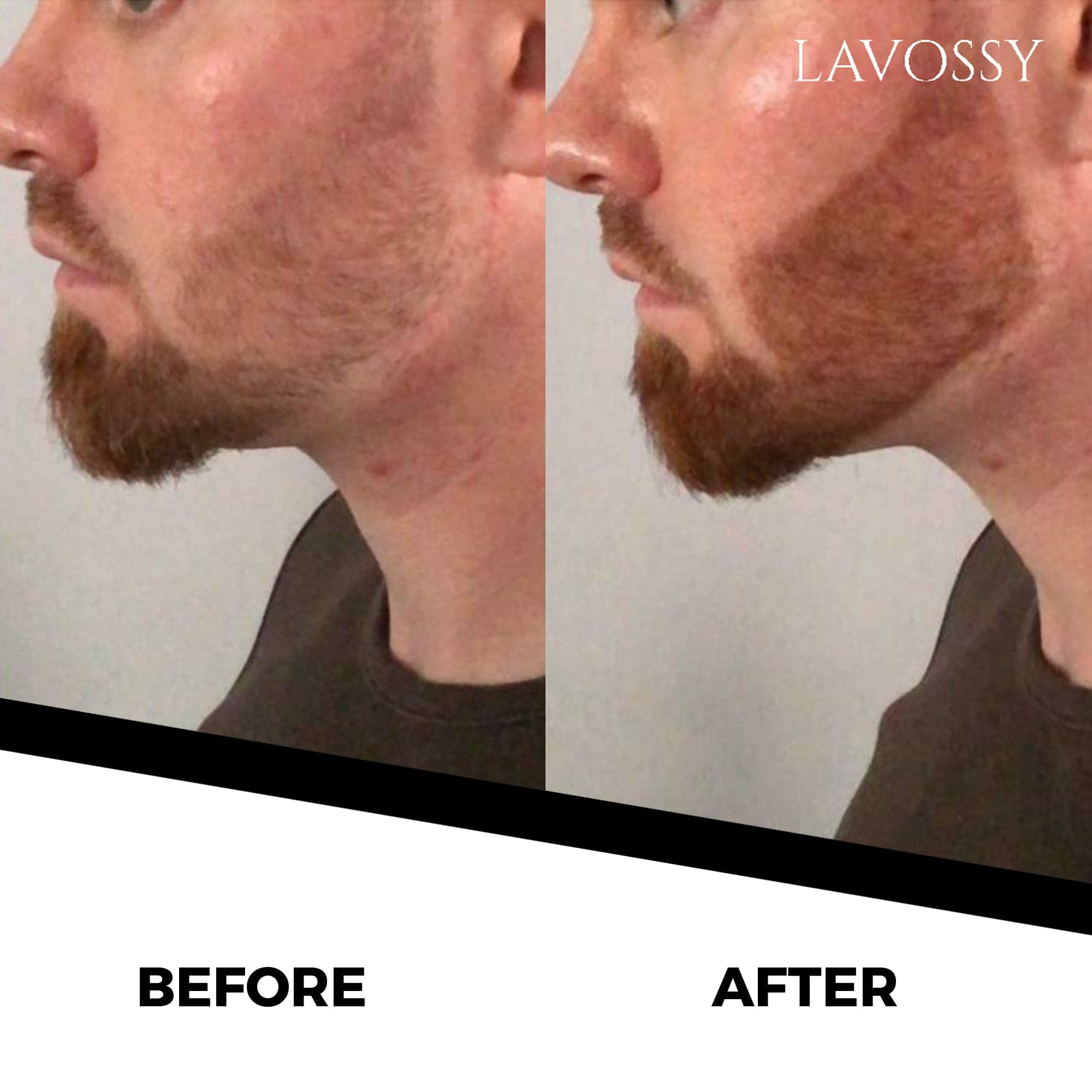 Before/After beard